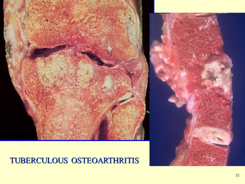 TUBERCULOUS OSTEOARTHRITIS 35